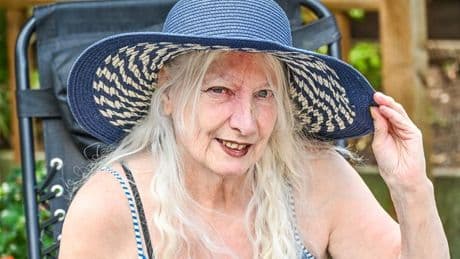 Gran's garden nap left her with sun poisoning and triggered shingles agony