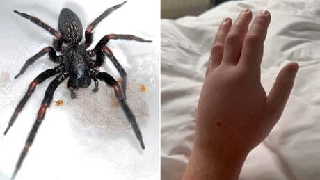 Australian spider with an 'excruciating bite' arrives in Britain: Cotswolds tourist is left with a hand 'like a balloon' after encounter