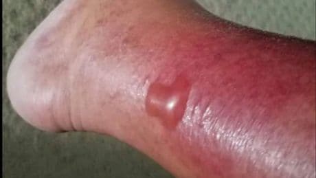 What is Vibrio vulnificus? Symptoms explained as beachgoers warned about flesh-eating bacteria