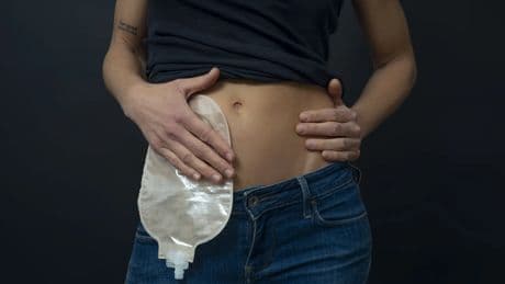 España apenas cuenta con más de 500 baños adaptados para las 210.0000 personas ostomizadas