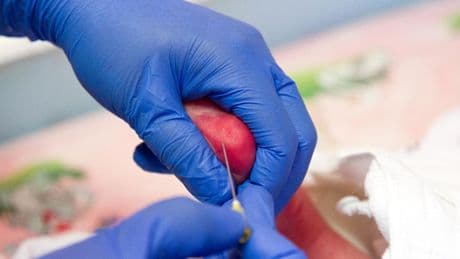Malattie rare, la ricerca clinica rallenta  e screening neonatali fermi a 9 anni fa
