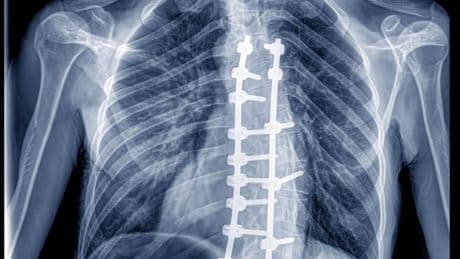 How Safe Is Spine Surgery? What To Know And What To Ask Your Surgeon