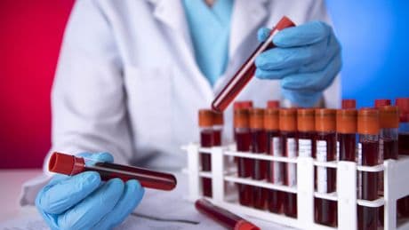 Alzheimer, la diagnosi precoce ora si fa con un test del sangue