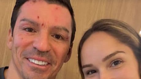 El exfutbolista Lúcio difunde la primera imagen de sus heridas tras la explosión de una chimenea en su casa