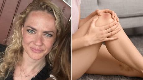 I thought my legs were just itchy. Then the bruising started... the horror cause lurks in a drink Americans have every day