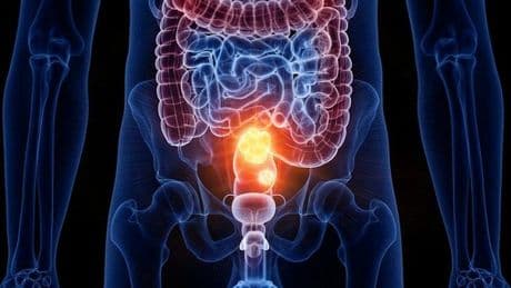 Tumore al colon-retto, una combinazione di farmaci rende la malattia sensibile all'immunoterapia: lo studio