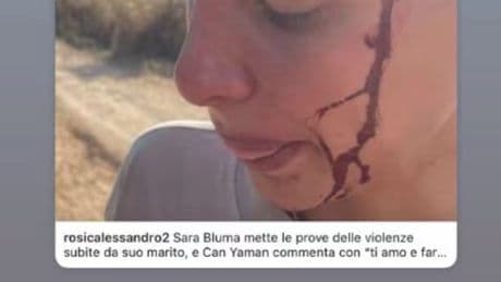 Sara Bluma rivela le foto delle violenze domestiche. Can Yaman: "Ti sosterrò"