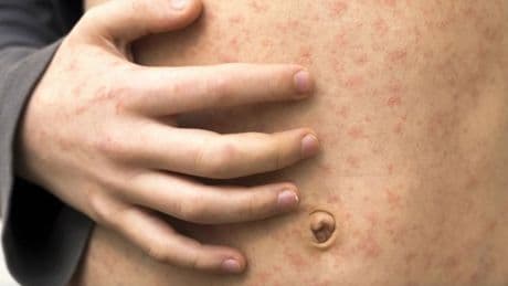AHS warns of possible measles exposures in Taber, Whitecourt and Grimshaw
