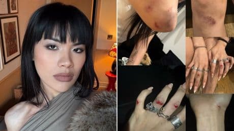 Trans woman ‘covered in blood and bruises’ after transphobic attack in street