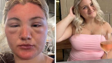 'My holiday sunburn almost exploded my face – my own mum didn't even recognise me'