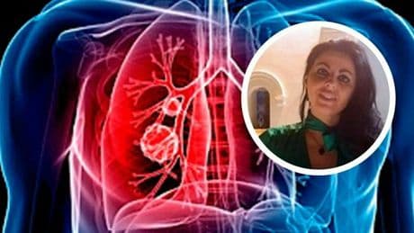 Valentina Greco e l'embolia polmonare: cos'è, sintomi, cure (farmaci anticoagualnti), cause