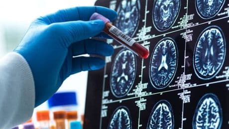 Breakthrough blood test diagnoses Alzheimer's early with 95% accuracy