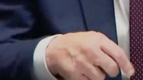Donald Trump's bruising mystery deepens as another shock photo emerges