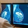 New test taken two weeks after starting treatment for breast cancer can tell if the disease is likely to return