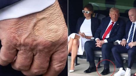 Donald Trump, le gambe gonfie e i lividi sulle mani: ecco cos'è l'insufficienza venosa cronica diagnosticata al presidente Usa