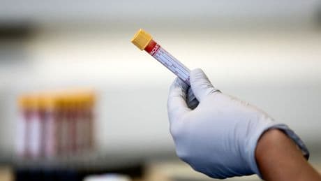 Simple blood test offers new hope to lupus patients