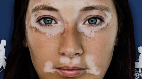 Wunderschön anders: Wie Sabrina trotz eines Makels zum Model wurde