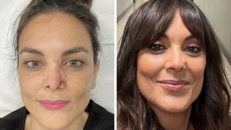 Mónica Carrillo muestra las cicatrices de su cáncer de piel: «Sin filtros ni retoques, así ha sido mi evolución»