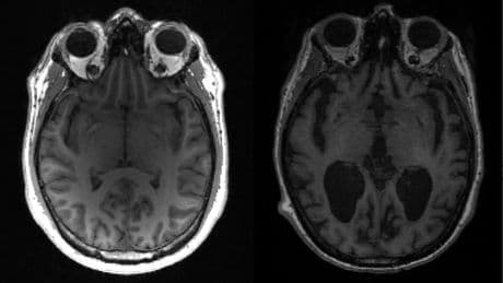 Une future thérapie contre Alzheimer? Le CNRS avance une piste prometteuse grâce aux dromadaires