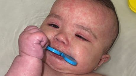 Alberta baby recovering from measles faces ‘long, painful road’