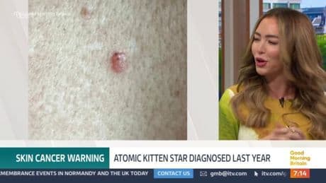 Atomic Kitten star Natasha Hamilton, 42, mistook skin cancer for mosquito bite