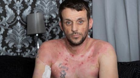 Man burned alive at horror house party fears he will "never hold son again" after injury hell