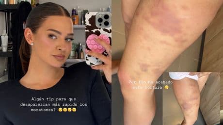 Laura Escanes muestra una preocupante foto de sus piernas amoratadas y pide ayuda: &quot;¿Algún tip para que desaparezcan rápido?&quot;