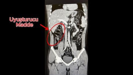 Havalimanında yakalanan 2 şüpheli, 35 kapsül eroin yutmuş
