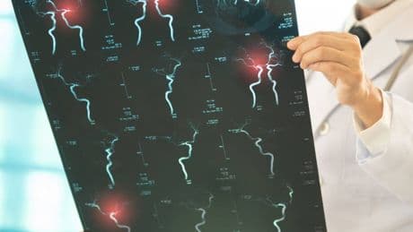 Dr. Fernández Ferro: “Un ictus es como una ruptura biográfica: un antes y después para el paciente”