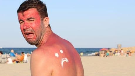 Dermatologist warns three sunburn ‘remedies’ could cause chemical burns - and two that actually work