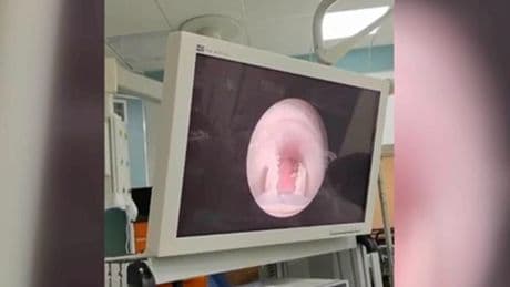 Yutkunamıyordu! Yemek borusundan et parçası çıktı