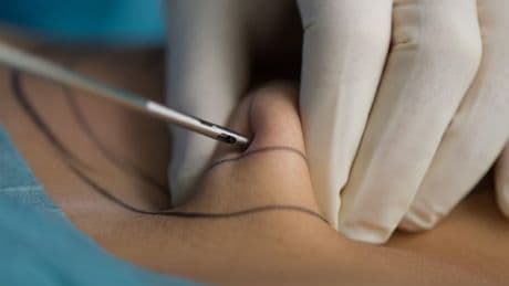Lipödem: Krankenkassen übernehmen künftig Kosten für Liposuktion
