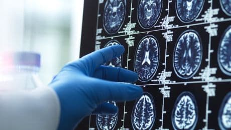 Blood tests for Alzheimer’s could be life-changing – but not always for the better