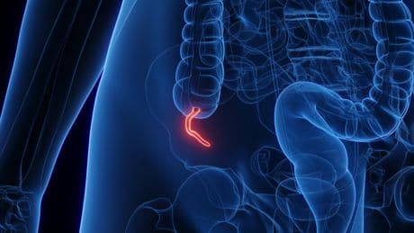 Appendix Cancer Has Quadrupled in Millennials