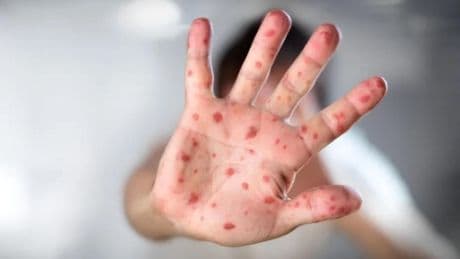 Muere un hombre en España tras contraer la viruela del mono: no estaba vacunado y tenía una infección por VIH