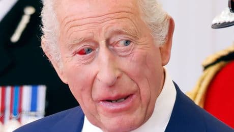 Blutiger Blick! - Aufregung um das Auge von König Charles