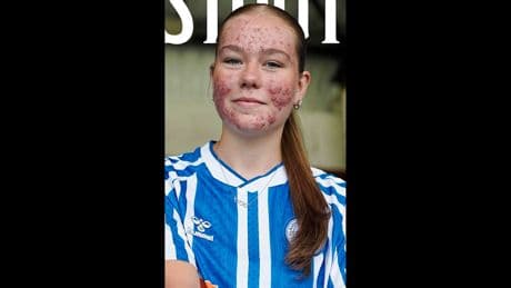 Ekelhafte Hass-Kommentare - Fußball-Talent wegen Akne angefeindet