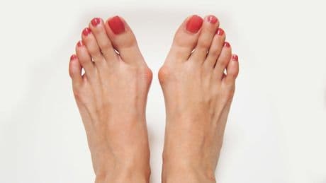 Ursula (64) hatte einen Hallux Valgus - „Endlich lassen die Schmerzen nach“