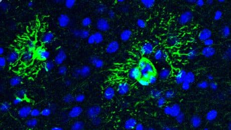 El Alzheimer comienza mucho antes que sus síntomas. Y hemos descubierto uno de sus primeros mecanismos