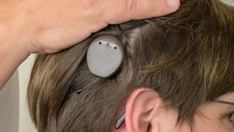 Wenn das Hörgerät nicht mehr ausreicht: Smartes Implantat ermöglicht Hören