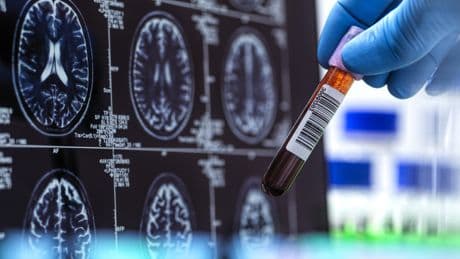 First FDA-cleared Alzheimer's blood test could make diagnoses faster, more accurate