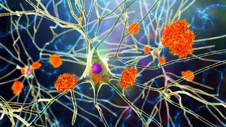 Demenz: Diese Risikofaktoren für Alzheimer haben Sie in der Hand