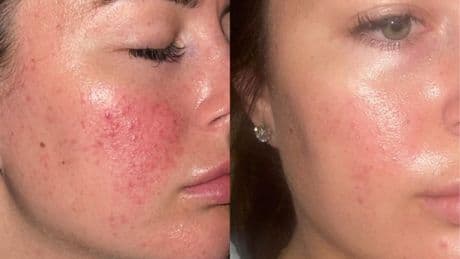 Yorkshire skincare brand shoppers 'wish' existed 'when my breakouts were bad as a teen'