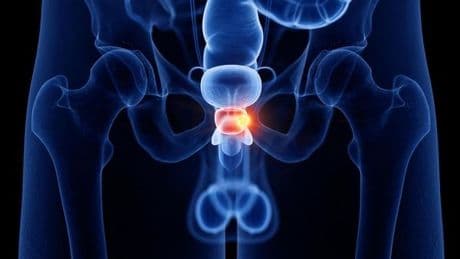 Prostatakrebs: Diese Vorsorge bringt wirklich etwas