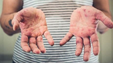 Alberta reports 17 more cases of measles, bringing total to more than 200