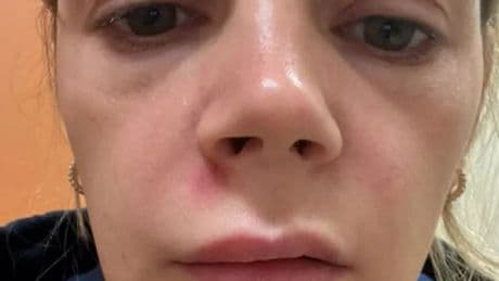 Mum hospitalised squeezing spot on 'triangle of death' area of face