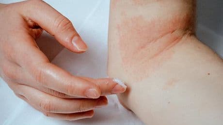 Concern as skin condition that hits millions is linked to raised risk of suicide
