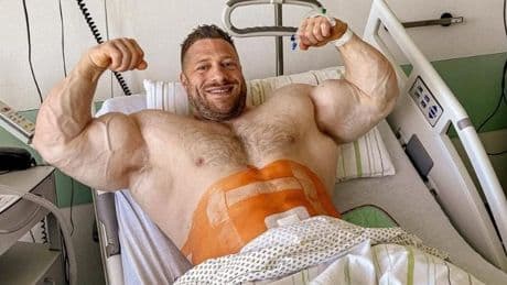 „Brutal hässlich“ - Bauch-OP stoppt Bodybuilder!
