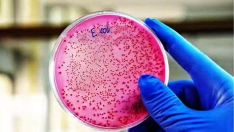 Un estudio asocia el cáncer colorrectal en personas jóvenes con una infección bacteriana en la infancia