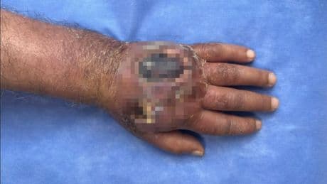 Üsküdar'da tıp tarihine geçecek vaka: Hırsızın ısırığı kolundan ediyordu
